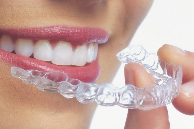 ortodoncia invisible invisalign