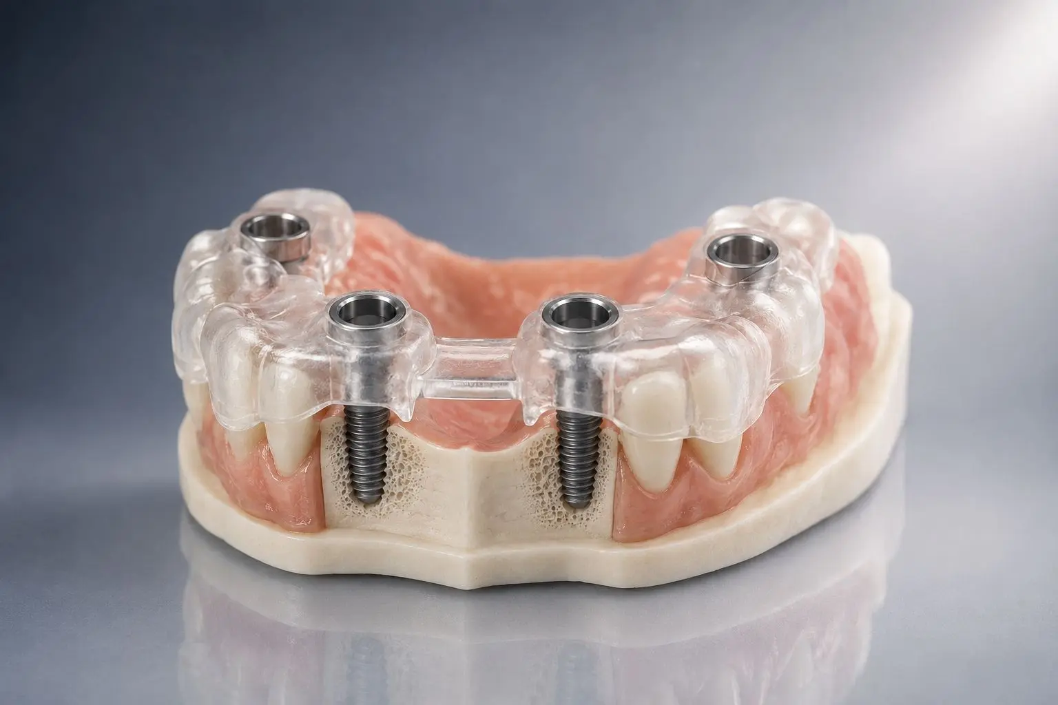 Implantes dentales cirugía guiada en DENTAL22