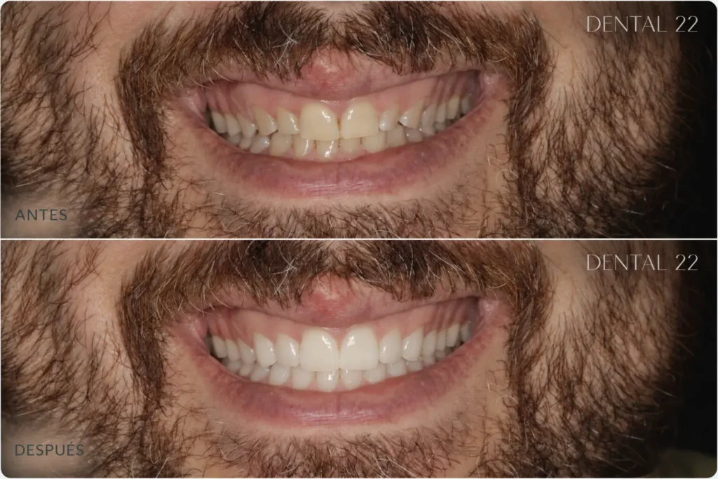 Antes - Después Carillas Poblenou DENTAL22