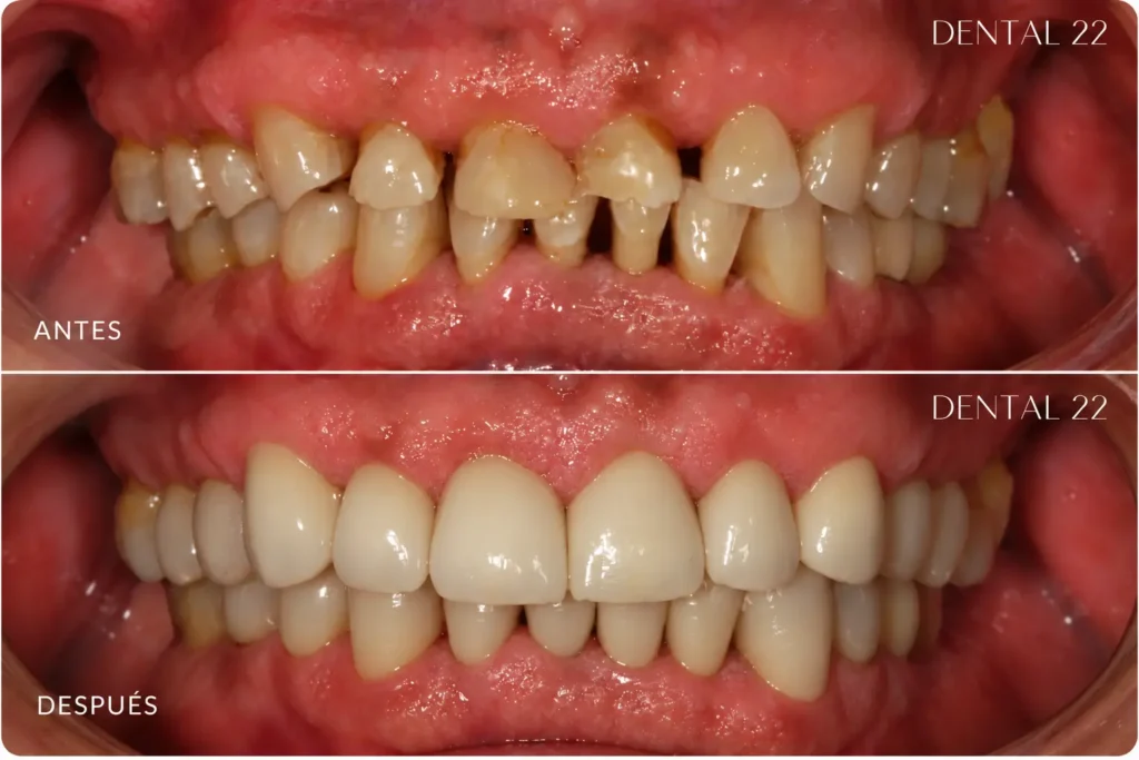 Antes y después de Carillas dentales en Clíncia Dental22 en Poblenou, Barcelona