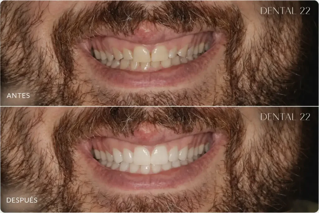 Antes y después tratamiento Carillas Dentales en Clinica DENTAL22 en Poblenou, Barcelona